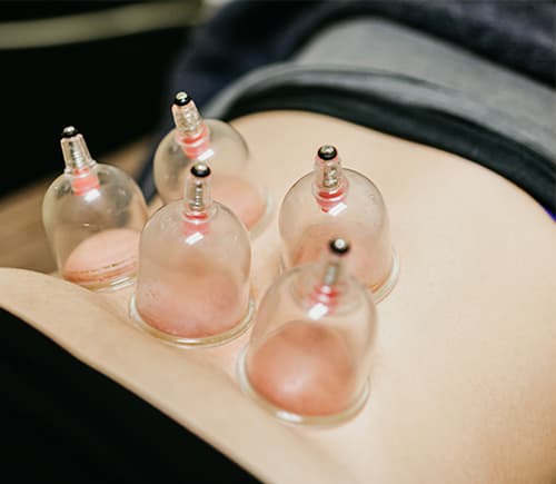 Cupping